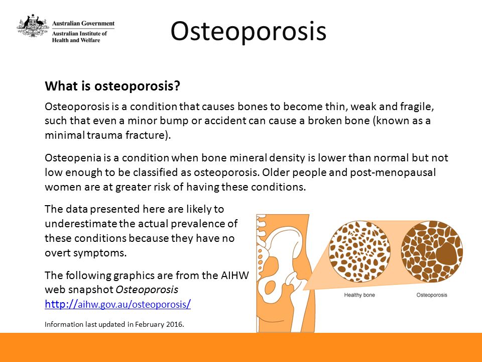 Como prevenir la osteoporosis